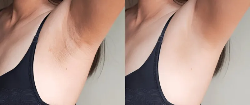 how to remove underarm darkness in tamil