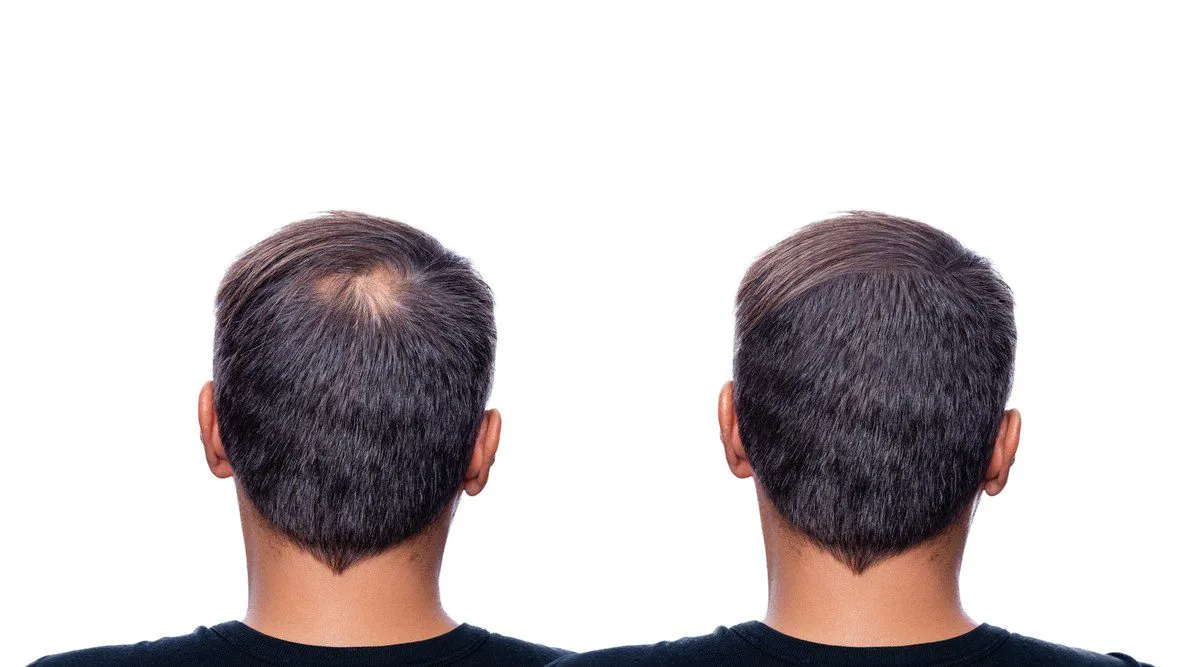 இழந்த முடியை மீண்டும் பெற இந்த 3 டிப்ஸை பின்பற்றினால் போதும்! | 3 Best Hair Regrowth Tips In Tamil