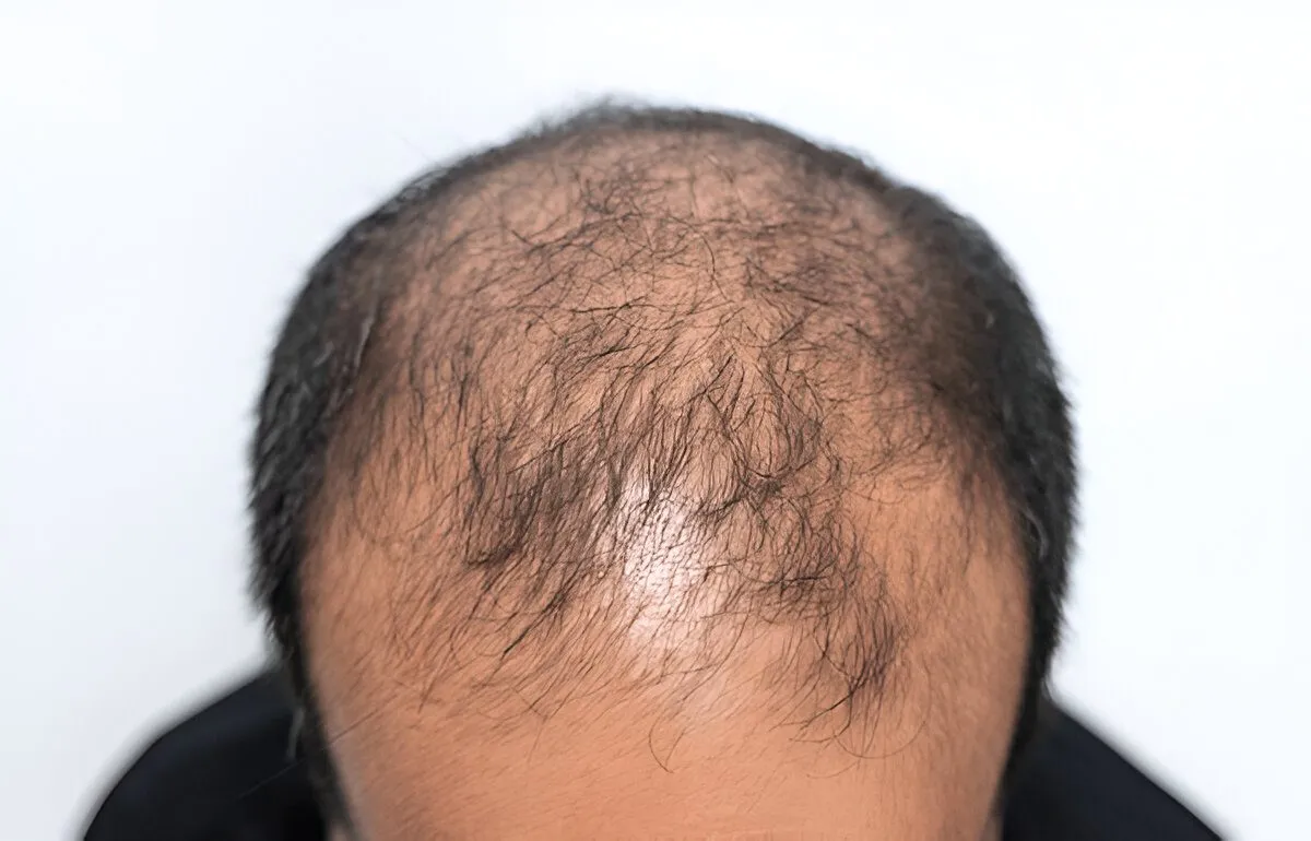 உங்கள் தலைமுடி உதிர்வதால் கவலையில் இருக்கிறீர்களா? வழுக்கை தலை உங்கள் தன்னம்பிக்கையை குறைக்கிறதா? | hair growth in bald head tips in tamil