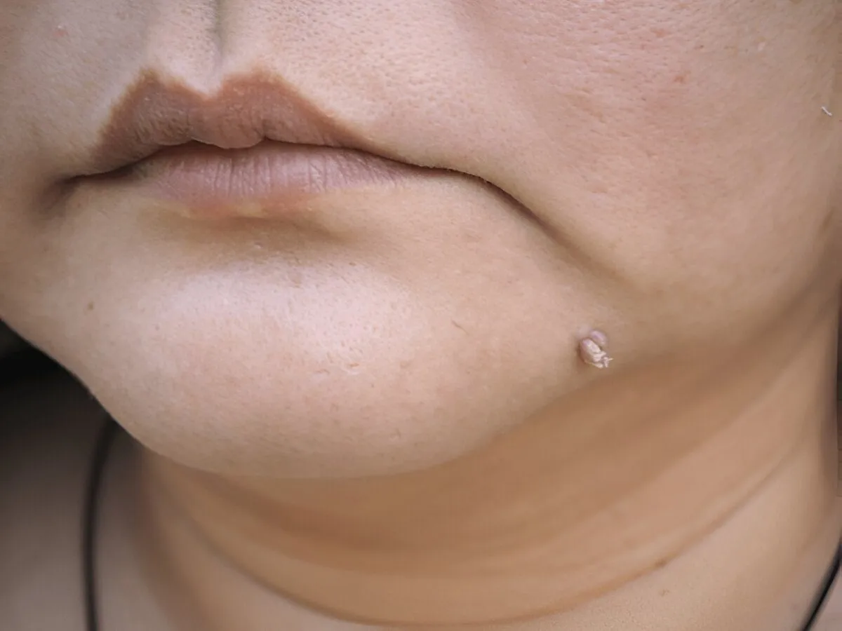 how to remove warts naturally using only 1 ingredient in tamil